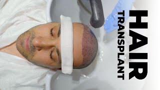 Hair Transplant - Full Journey 2023