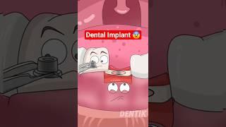 How Dentists Replace Missing Teeth with Screws  (Tooth Implant Explained!)