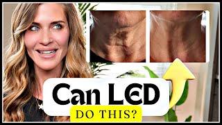 EXPERT Guide to LED: Melasma,  Eye Health, Fat Loss...What LED can and can't do  with Bev Sanderson