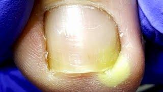 A Small Ingrown Toenail Hurts The Toe! Treatment [Dr. Liu's Pedicur]