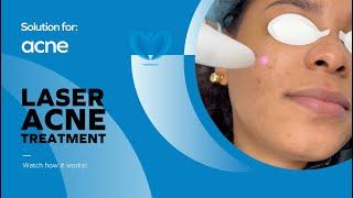 Stop Acne - Watch how Laser Acne Treatment is performed | Get Rid of Skin Blemishes