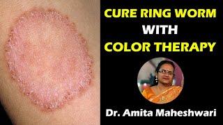 Video 46 - Cure Ring Worm with Color Therapy - Dr. Amita Maheshwari