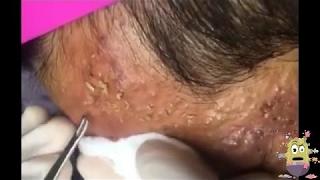 Extraction Of Severe Cystic Acne Pimples On Face!!