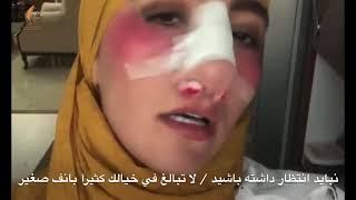 عملية تجميل الانف اللحمي قبل وبعد / لا تبالغ في خيالك كثيرا بانف صغير جدا مثل الانف اللحمي