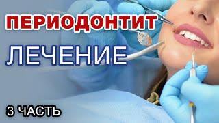 Лечение периодонтита - это риск? Можно ли вылечить периодонтит? / Часть 3