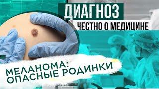 Меланома: как распознать опасные родинки? | Диагноз