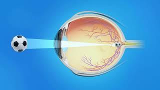 Nearsightedness (Myopia)