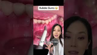 A whole new meaning to bubble gum. 🫧 #gums #bubblegum #dentist #swollen