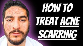 How To Treat Acne Scarring (2024)