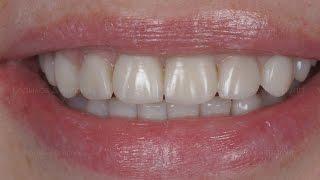 Композитные виниры. Composite veneers. Виниры до и после