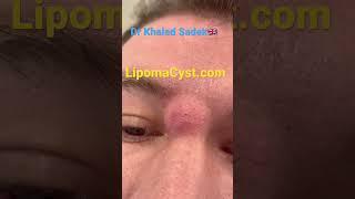 Massive face cyst removal Dr Khaled Sadek #acne #blackheadremoval #skinadvice LIPOMACYST clinic