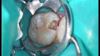 Direct pulp capping with Bright MTA Capping (Prof.Duck-Su Kim)