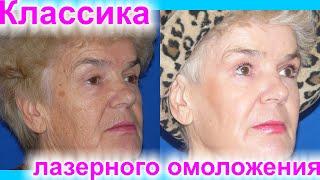 Лазерная шлифовка лица. В 65 лет возможно выглядеть на 40! Реальные результаты До/После. #2