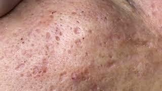 Remove perennial blackheads around lips and under chin 2024 | ACne Treatment Channel