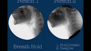 Swallowing postures and maneuvers with videofluoroscopy (two healthy adults)
