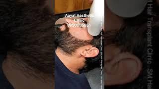 Laser Hair Removal Treatment | SM Hair Transplant | Panipat | Shamli #shorts