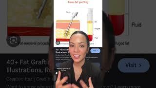 All about fat grafting - I’ve seen a big increase in patient requests for this procedure in 2024,
