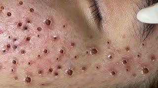Loan Nguyen Acne Treatment 6x