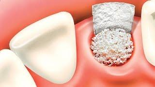 Bone grafting procedure