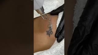 Tattoo removal primarily involves using laser technology, ️️️️