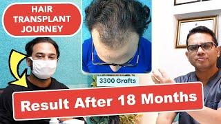 Hair Transplant Journey of 18 Months | Best Hair Transplant Surgeon- Dr. Jangid | Delhi