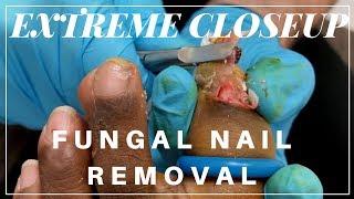 Entire Toenail Removed in Seconds | Tampa Podiatrist