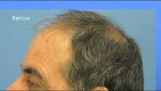 Dr.Jerry Wong 5946 grafts - 1 session