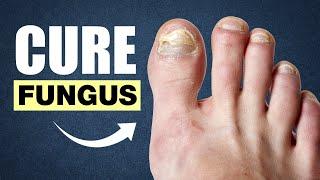 10 Effective Home Remedies To Cure Toenail Fungus