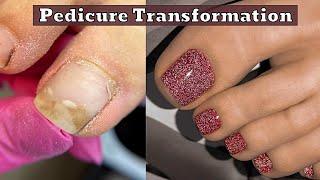 Ingrown Toenail Pedicure Satisfying Nail Cleaning 