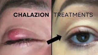 Chalazion Treatments: No-Cut NICE Therapy @GulaniVision