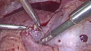 Recurrent Contralateral Consecutive Ectopic Pregnancy • Video • MEDtube net