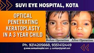 Optical Penetrating Keratoplasty in a 3 Year Child  SuVi Eye Institute & Lasik Laser Center Kota In