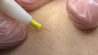 Electrolysis hair removal