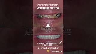 Full Mouth Reconstruction with Dental Implants in Tulsa | No Dentures | Smile Makover | FOURSTRONG