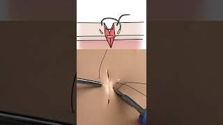 Figure of 8 Suture