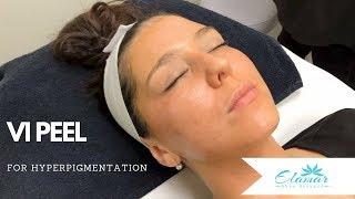 VI Peel® | Chemical Peel for Hyperpigmentation