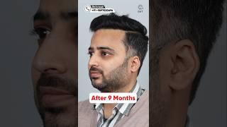 Nine Months Hair Transplant Results | Latest Fue Technique #shorts #viral #hair transplant