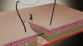 Suture Techniques - Horizontal Mattress U-Shaped Suture