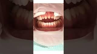 Porcelain veneers procedure | porcelain veneers before and after | Dr. Yazdan | dental veneers