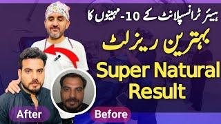 Hair Transplant 10-Months Live Result || Hair Transplant Perfect Result || Dr. Habib