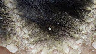 Dandruff scratching removal on head using black combing#181