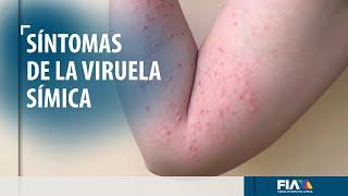 Viruela símica, síntomas y formas de contagio