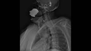Digital Radiology Retrospective View of Esophagus: Esophagogastroduodenoscopy (SEGD Test) part 1