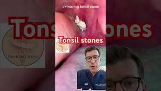 Removing tonsil stones #shorts