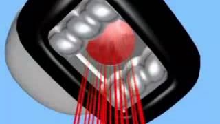 Adiós a la celulitis con la tecnología Elos