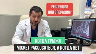 Лечение грыжи позвоночника без операции | резорбция грыжи | удаление грыжи диска позвоночника.