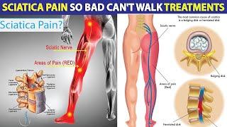 Sciatica: Causes, Symptoms and Treatments | Sciatica Pain So Bad Can't Walk Treatments