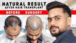 Classic Hair Transplant Result | Natural Hairline with High density Hair Transplant Result