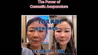 The Power of Cosmetic Acupuncture#szenanphua #acupuncture #acutcmschool #cosmetic