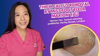 Thick Callus removal by Miss Foot Fixer Marion Yau